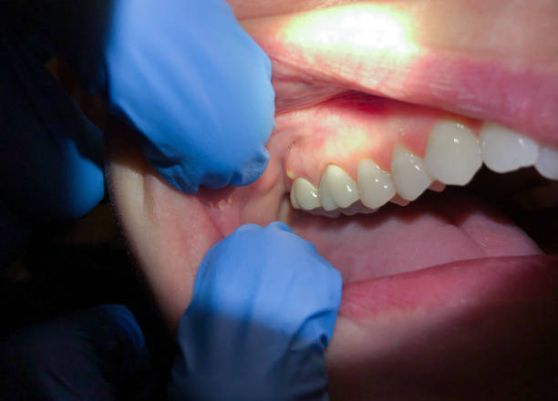 Best Emergency Gum Treatment in South Browning, MT